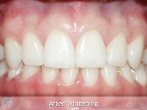 After Teeth Whitening