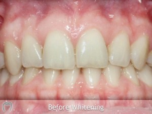 dublin laser teeth whitening