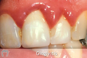 bad gingivitis