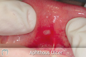 ulcer on floor of mouth