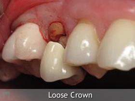 crown broken dental loose dentist emergency