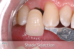  - implant-crown-shade-selection_300x200